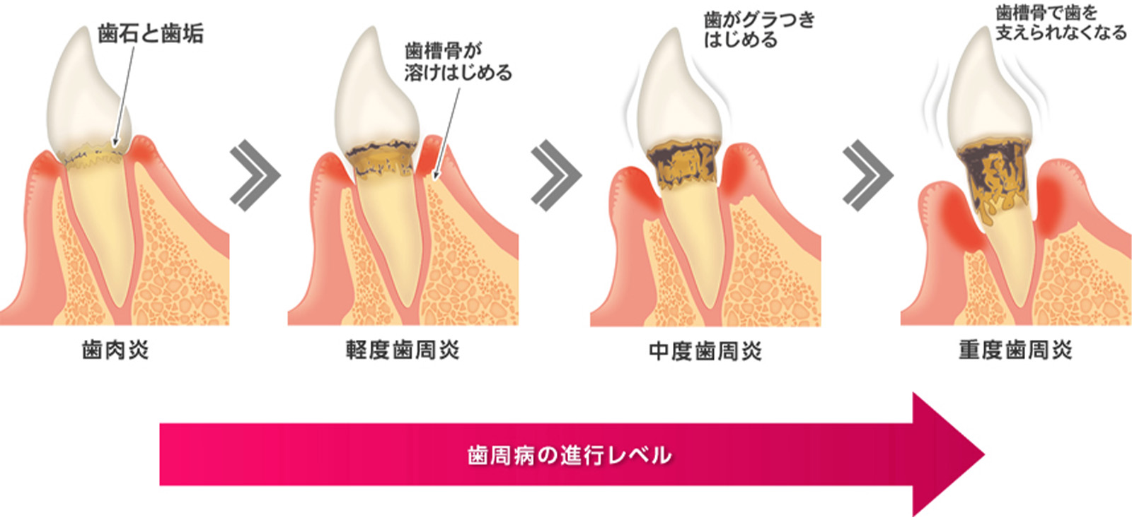 歯周病の進行